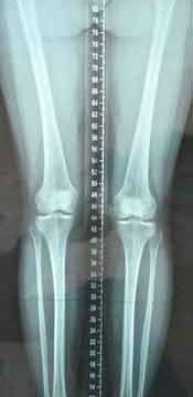 rupture du ligament croisé
