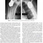 Results of a stemless reverse shoulder prosthesis, results at more than 58 months mean without loosening Dr Ballas