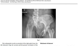 Ballas-JBS-2017-Fourteen years follow-up of massive pelvic girdle osteolysis caused by lymphatic malformation