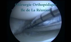 Suture méniscale du genou - Dr Ballas