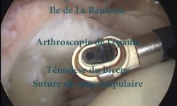 Suture coiffe arthroscopie